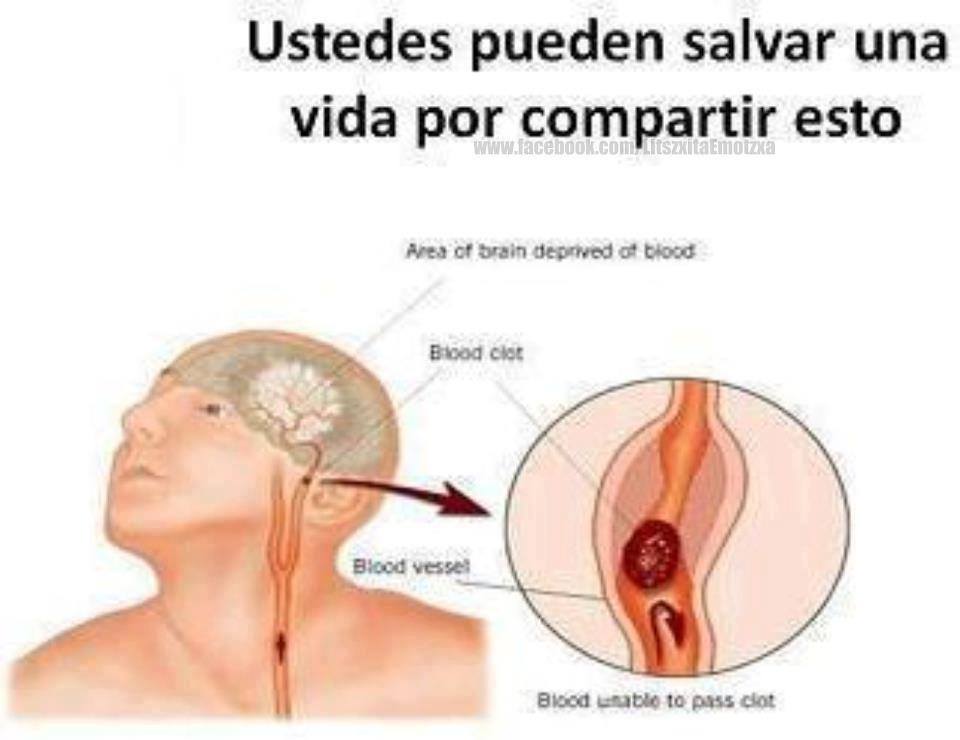 CÓMO ACTUAR ANTE UN DERRAME CEREBRAL